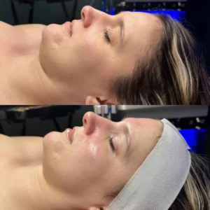 skin-before-and-after-five by Healthy Glow Beauty in Rowley MA
