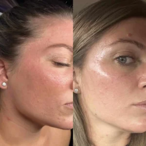 skin-before-and-after-one by Healthy Glow Beauty in Rowley MA