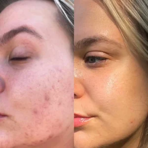 skin-before-and-after-two by Healthy Glow Beauty in Rowley MA