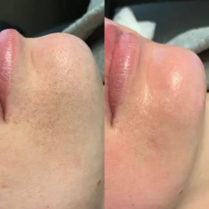 skincare-before-and-after-six by Healthy Glow Beauty in Rowley MA