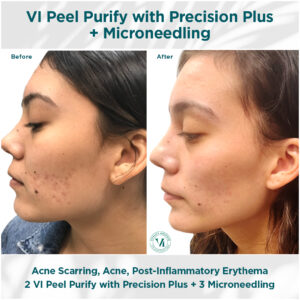 Acne, Acne Scarring, PIE