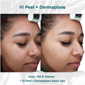 Acne, PIH _ Texture