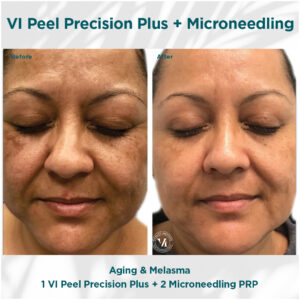 Aging _ Melasma