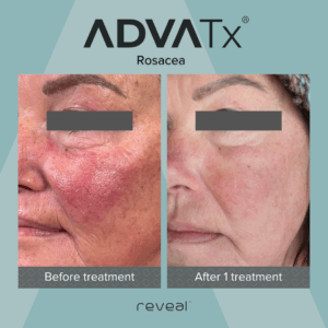 Rosacea_FyreAesth_B&A_1