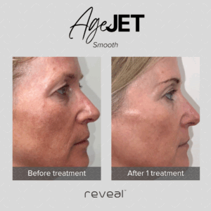 2023_08_26_AgeJET_B&A_2