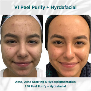 Acne, Acne Scarring _ Hyperpigmentation